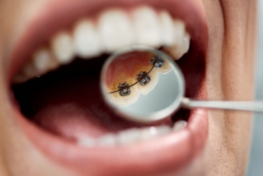 Lingual Ortodonti ile İlgili Yanlış Bilinenler